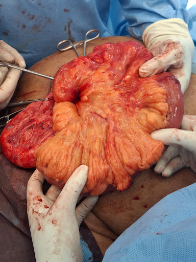 Post Surgery: Giant Incisional Hernia Surgery