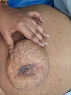 Pre Surgery: Giant Incisional Hernia Surgery