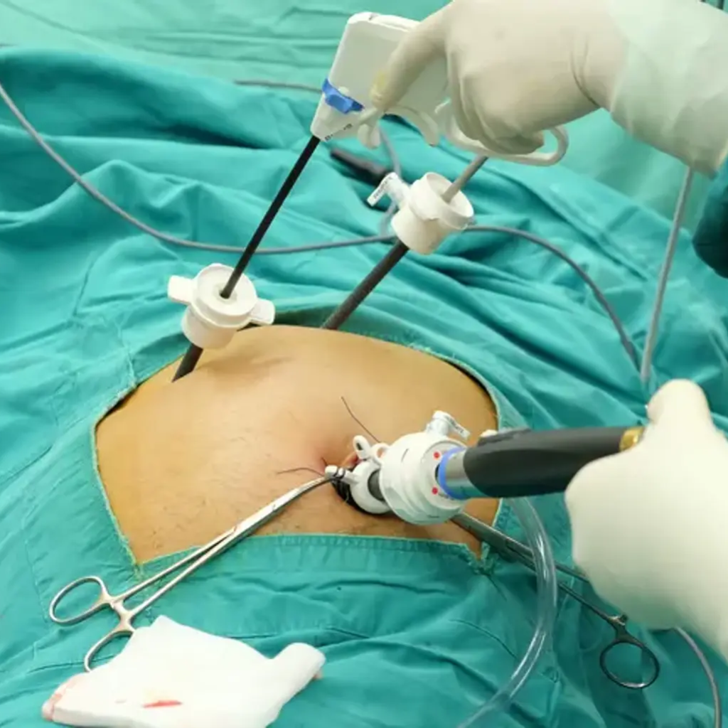Laparoscopic Gallbladder Removal?